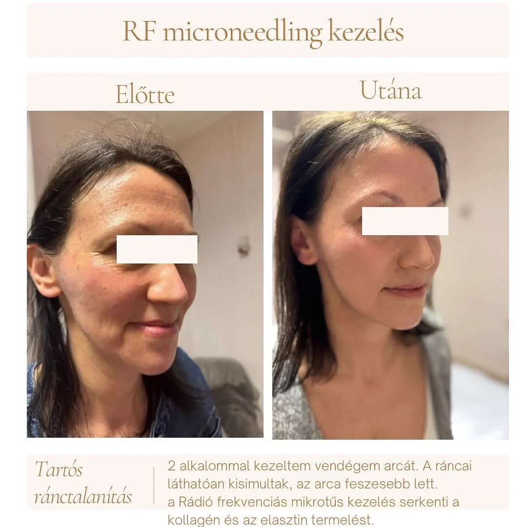 Referencia 4: előtte és utána