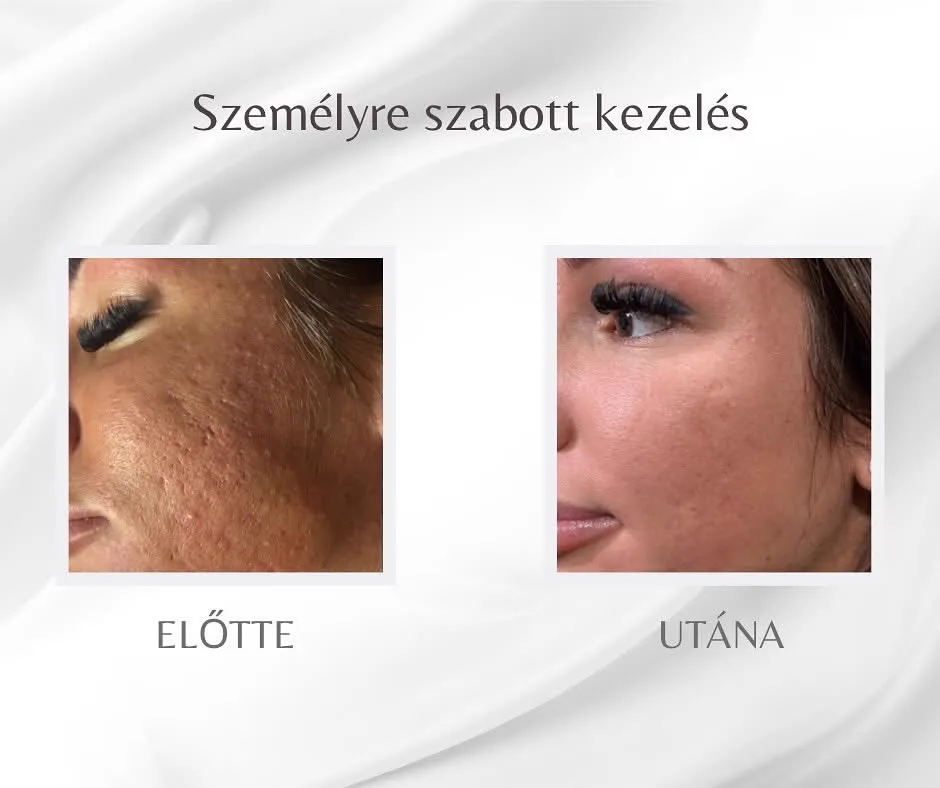 Referencia 6: előtte és utána